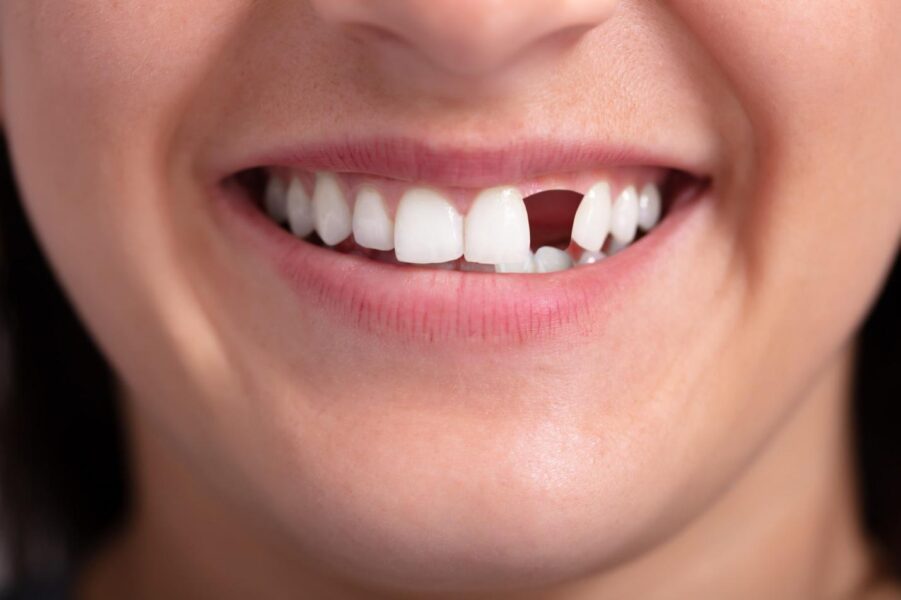 5 Solutions for Missing Teeth