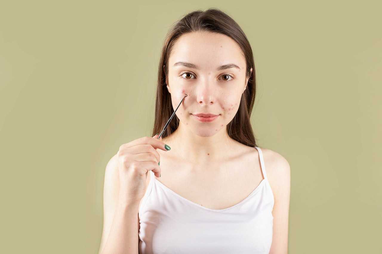5 Things to Know About Acne Scars