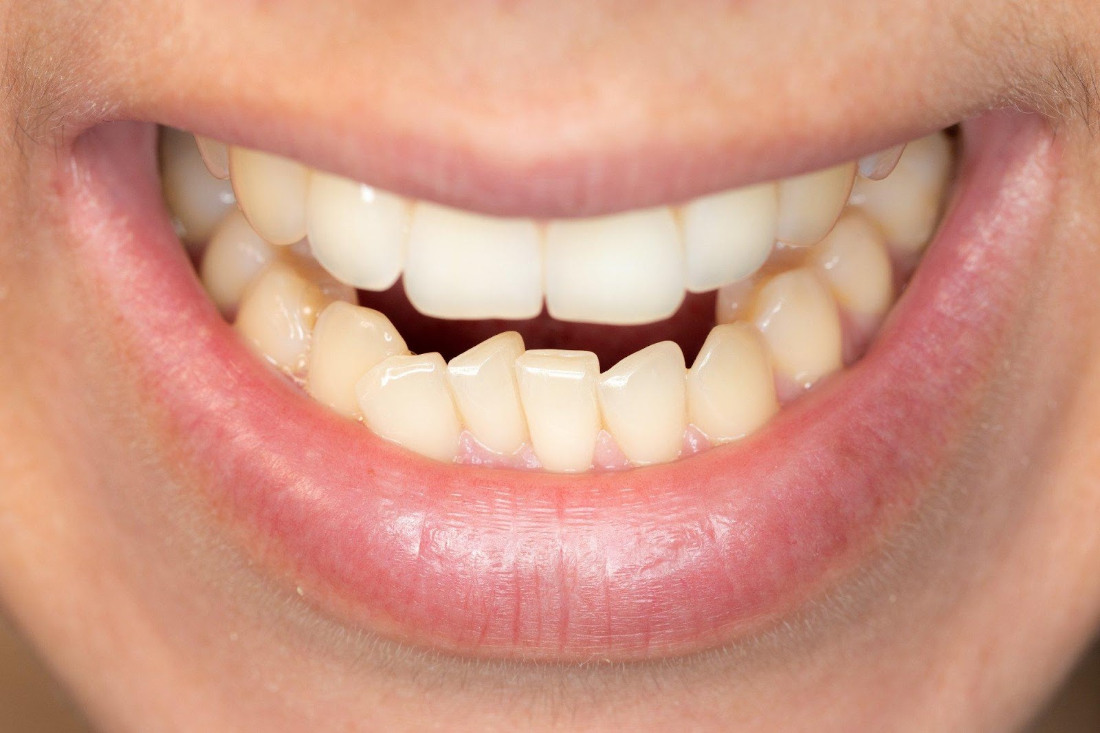 The Top Treatment Options for Straightening Crooked Bottom Teeth