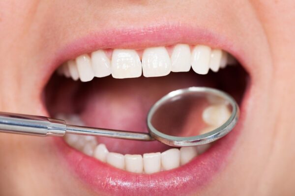 Exploring Treatment Options for Cavities Between Teeth: From Fillings to Sealants